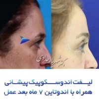 لیفت اندوسکوپی پیشانی
