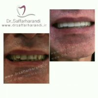 کامپوزیت نانو هیبرید