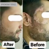 آیا اگزما درمانی هم دارد؟