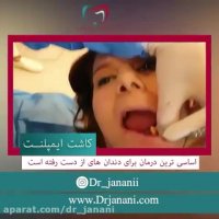 کاشت ایمپلنت دندان به چه صورت است ؟