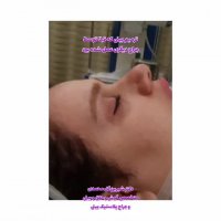 عمل زیبایی ترمیمی بینی