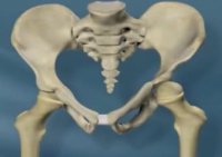 دیسپلازی مفصل ران در لگن