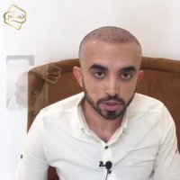 کاشت مو به روشSUT -کلینیک تخصصی رنسانس