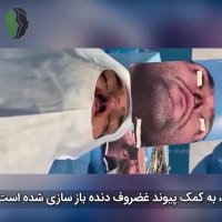 یکماه بعد از جراحی ترمیمی بینی با پوست ضخیم | دکتر باستانی نژاد