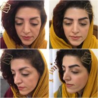 کاشت ابرو طبیعی بدون کوتاهی موی سر