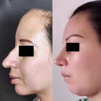 جراح برتر مشهد ( عمل بینی مشهد ) | 09380000893