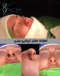 نمونه عمل زیبایی بینی