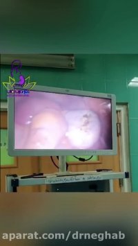 فیلم کوتر تخمدان در فرد نابارور با سندروم تخمدان پلی کیستیک