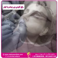 رفع گودی زیر چشم با تزریق فیلر