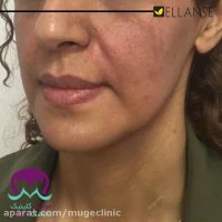 اصلاح ناحیه مید فیس با تزریق الانسه