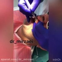 درمان لثه های نا متقارن به وسیله لیزر بدون درد و خونریزی