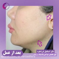 زاویه سازی صورت با تزریق چربی