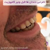 فیلم نمونه کار ونیر کامپوزیت