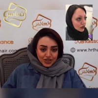 فیلم کاشت ابرو -کلینیک تخصصی رنسانس
