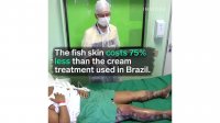 Doctors Are Using Fish Skin to Treat Burns