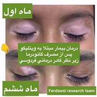 برص درمان شد