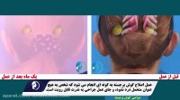 نتیجه آنی اصلاح گوش برجسته به روش دائم