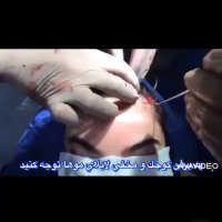 لیفت آندوسکوپیک ابرو توسط پروفسور کشکولی | جراح پلک