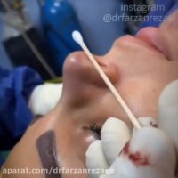 جراحی بینی و تزریق چربی به چانه