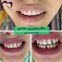 4 واحد کامپوزیت فک بالا برای بستن فاصله بین دندان ها