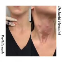 جوانسازی گردن با پروفایلو