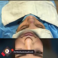 بلافاصله پس از عمل بینی | دکتر گلی