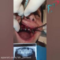 ایمپلنت فول فک بالا