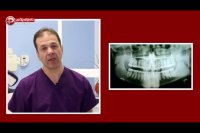 گفت و گوی اختصاصی تی وی پلاس با دکتر شهرام عظیمی در ارتباط با مفهوم، دلیل و روند عصب کشی دندان