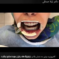 کامپوزیت ونیر ده دندان بالا و انجام بلیچینگ دندان های فک پایین جهت تطابق رنگ