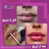 تزریق ژل لب دکتر مریم حبیبی زاده