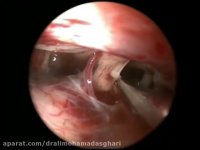 بیماری منییر