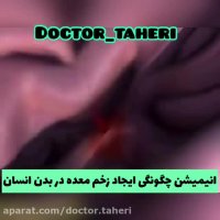 چگونگی ایجاد زخم معده در بدن انسان