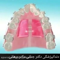 تامین فضا با استفاده از افزایش عرض و طول قوس دندانی