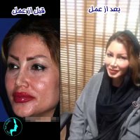 تزریق چربی و جوانسازی پوست | دکتر گلی