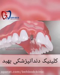 نگاهی به عملکرد ایمپلنت های دندانی و نقش آن در زیبایی لبخند