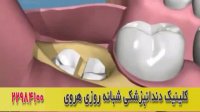 ویدیو جراحی دندان عقل