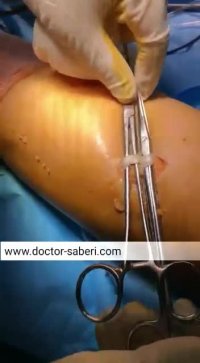 بخشی از عمل رباط صلیبی