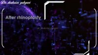 قبل و بعد از جراحی بینی | دکتر شهریار یحیوی