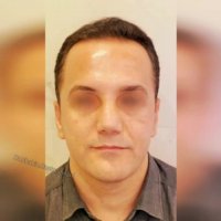 یکسال بعد از عمل ترمیمی بینی