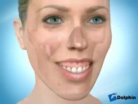 دکتر مسعود داودیان :: درمان Gummy Smile (لبخند گوشتی) با ارتودنسی و جراحی فک