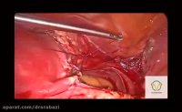 Laparoscopic hysterectomy