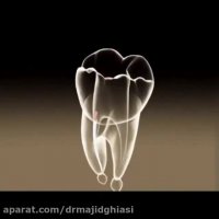 درمان روت کانال