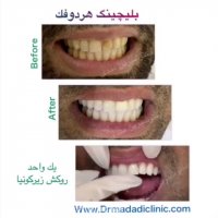 بليچينگ هر دو فك