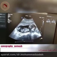 فیلم سونوگرافی جنین دوقلو