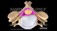 Neck Surgery | Cervical Disc Replacement | Nucleus Health