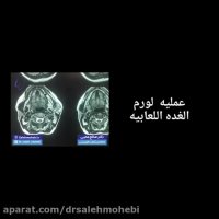 عملیه الورم الغده اللعابیه