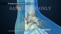 Ankle Fracture Surgery | Nucleus Health