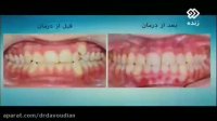 کشیدن دندان در ارتودنسی(قسمت اول) | دکتر داوودیان