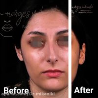 فیلم جالب از میزان تغییرات بعد از عمل بینی