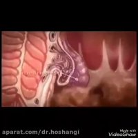 علل شایع بواسیر